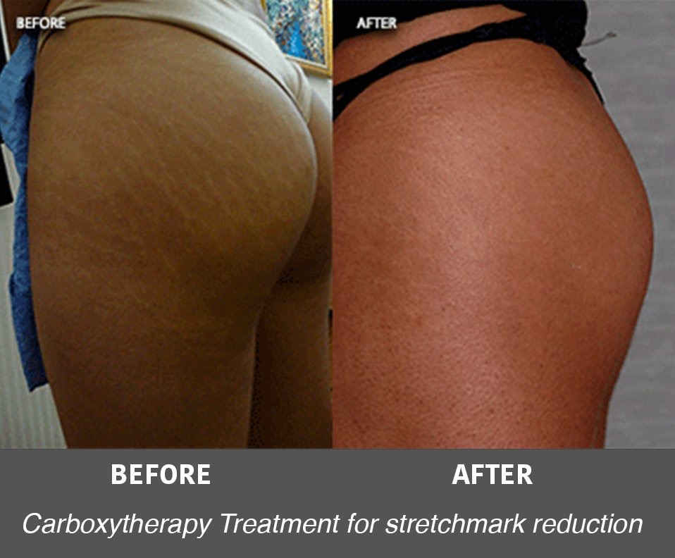 Carboxytherapy before and after at Neoderma Anaheim: stretch marks on the buttock and thigh visibly reduced