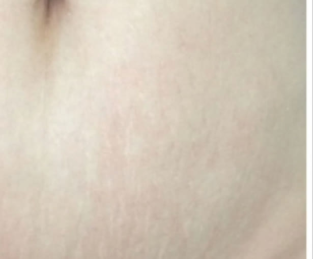 The same stomach stretch marks after one carboxytherapy session, visibly faded