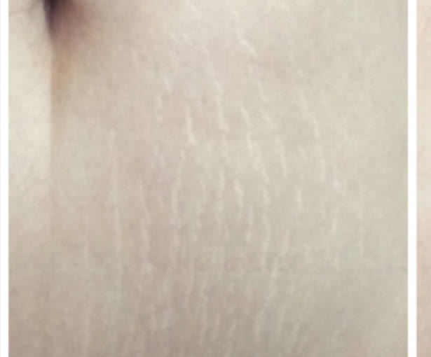 Stretch marks on the stomach before carboxytherapy at Neoderma, Anaheim